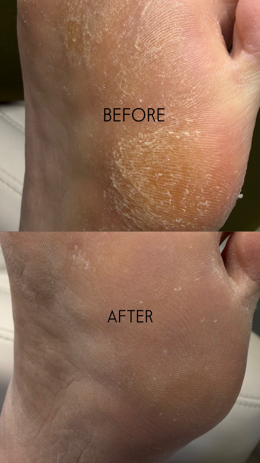 Callus & Crack Repair — before and after