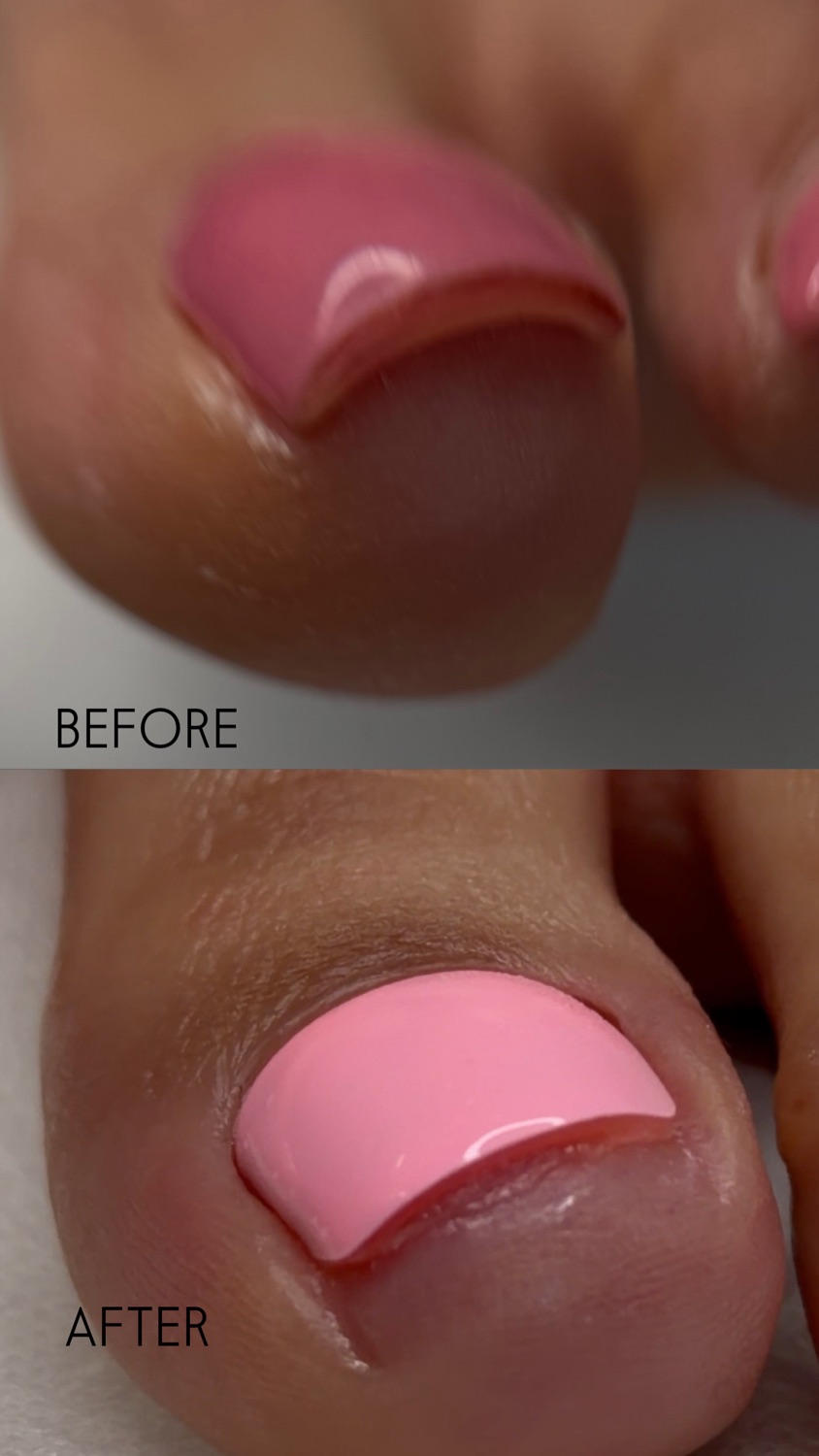 Nail Correction — before and after